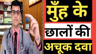 MOUTH ULCERS APHTHAE  मुँह के छालों की अचूक दवा  HOMEOPATHIC TREATMENT [upl. by Mikkel634]