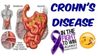 Crohns Disease The Only Video You Will Ever Need [upl. by Harolda]