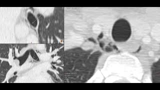 Traumatic pneumomediastinum  CT findings and basic diagnostic approach [upl. by Nylessej]