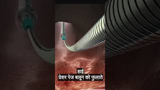 चलिए देखते हैं हार्ट की एंजियोप्लास्टी कैसे होते हैं3D Animation of Angioplasty Procedure [upl. by Lzeil567]