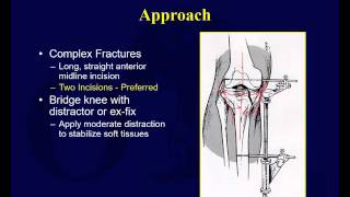 Tibial plateau fractures 1 [upl. by Ihp448]