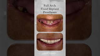 What does a successful full fixed implant prostheses look like dentalprosthetics implantdentistry [upl. by Annadiane921]