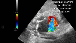 CASE 443 echo cardaic tamponade rheumatic mitral stenosis regurgitation AR TR PHT [upl. by Hilleary]