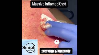 Massive Inflamed Cyst Incision amp Drainage [upl. by Oluap489]