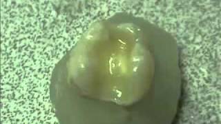 Sure Dental Surpass Instructions  YouTubeflv [upl. by Idelle490]