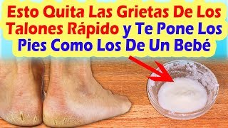 Esto Quita Las Grietas De Los Talones Rápido y Te Pone Los Pies Tan Suaves Como Los De Un Bebé [upl. by Phedra73]