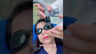 Laser Hair Removal getsmarthairclub viralvideo viralshort [upl. by Kwabena]