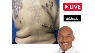 4 Keloids Removed At Once With Dr Keloid [upl. by Reisman]