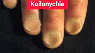 Leukonychia Platynychia and Koilonychia in Chronic iron deficiency anemia [upl. by Noxid]