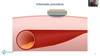 Marijn Groen High Intensity Focused Ultrasound Therapy for the Treatment of Atherosclerotic Plaques [upl. by Nerrawed]