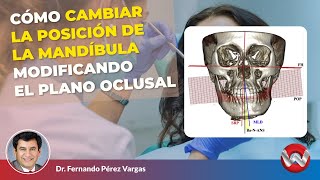 Cómo Cambiar la Posición de la Mandíbula Modificando el Plano Oclusal [upl. by Yruama]