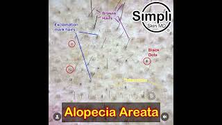 Alopecia Areata Dermoscopy [upl. by Netsruk823]