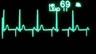 Atrial Pacing [upl. by Chrisoula]