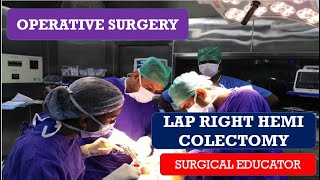 LAP RIGHT HEMICOLECTOMY STEP BY STEP OPERATIVE SURGERY [upl. by Loraine415]