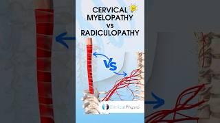 Cervical Radiculopathy vs Myelopathy physiotherapy physicaltherapy medical [upl. by Kat]