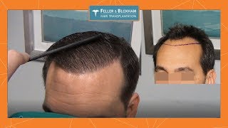 Wet quotSlickquot Hair Transplant Results  2500 Grafts  Feller amp Bloxham NY NYC Long Island [upl. by Willock]