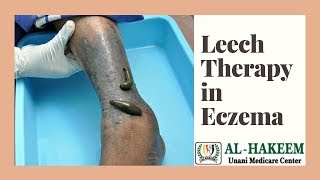 Leech Therapy Treatment in Eczema at Al Hakeem Unani Center [upl. by Alywt]