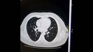 Chronic hepatic parenchymal disease HCCPulmonary metastases Horseshoe kidneys [upl. by Pomeroy584]