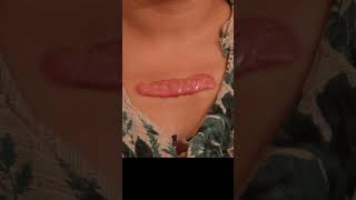 Chest keloid getting worse with steroid injections [upl. by Gruver]