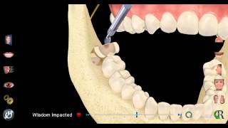 Impacted Wisdom Tooth Extraction [upl. by Merril270]