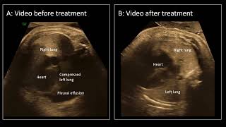 UOGJournal videoclip on the use of maternal propranolol treatment as therapy for fetal chylothorax [upl. by Shipley]