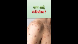 MPOX Monkeypox Information in Marathi  Symptoms  Transmission  Treatment [upl. by Daukas684]