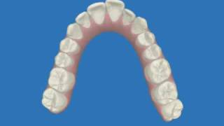 Clincheck Invisalign OrthoLemay 023145PDm4v [upl. by Milak]