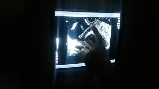 TVS for Caesarean Scar Assessment [upl. by Libna631]