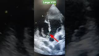 Perimembranous VSD Echo Ventricular septal defect shorts [upl. by Lain]