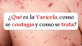 VARICELA Síntomas diagnostico y tratamiento de la Varicela [upl. by Auehsoj]