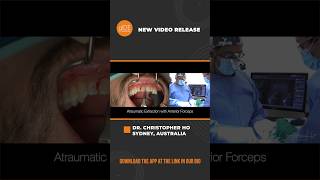 Immediate Tooth Replacement with Implant Placement and Temporization [upl. by Ayikaz]