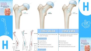 Coxa Valga and Coxa varafull description Coxavalga coxavara trending [upl. by Atselec]
