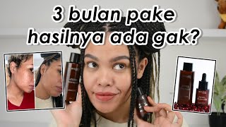 Ngilangin Bekas Jerawat dgn Retinol Lokal Avoskin Miraculous Retinol Ampoule amp Toner Review [upl. by Aihsoem]