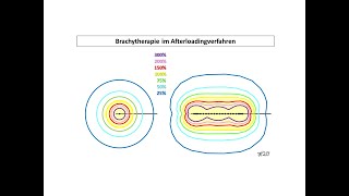 Afterloadingverfahren in der Brachytherapie  Strahlentherapie Prof Hilke Vorwerk [upl. by Gilcrest]