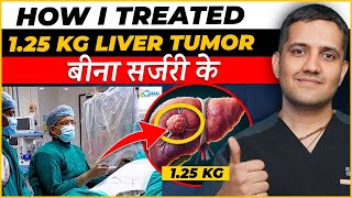 125 kg का liver tumor बिना सर्जरी के कैसे ठीक कर सकते है  No Major Scar  Dr Gaurav Gangwani IR [upl. by Aylmar]