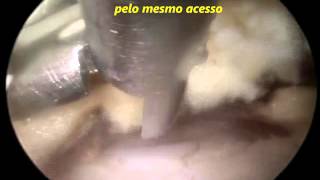 Vídeo Endoscopia de Coluna  Estenose de Canal Vertebral Lombar L45  Dr Marco Moscatelli [upl. by Ennaeiluj316]