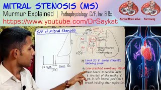 Mitral Stenosis MS  Pathophysiology  Murmur  Clinical Features  Treatment  Dr Saykat [upl. by Aydin]