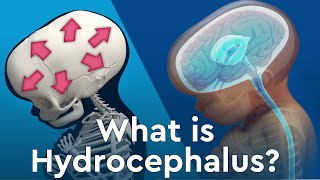 What is Hydrocephalus and Why Does Fluid Build Up in the Brain [upl. by Elda411]