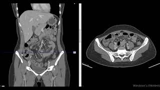 akut apandisit  apandisit perforasyonu apandisit komplikasyonları abdomen radyolojisi [upl. by Afton586]