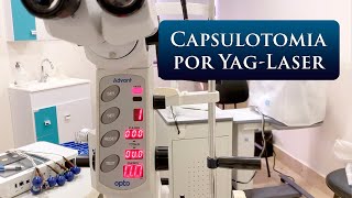 CAPSULOTOMIA POR YAGLASER [upl. by Hakeber377]