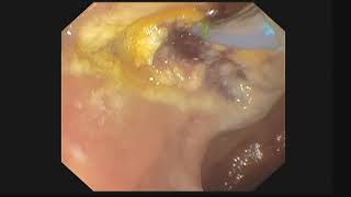 EUS evaluation and management of Ampullary lesions [upl. by Allwein]