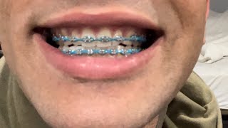 Braces Review teeth [upl. by Arykat390]