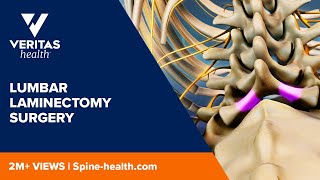 Lumbar Laminectomy Surgery [upl. by Atiloj]