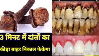 भयंकर से भयंकर दर्द 3 मिनट में खत्मclove oil for teeth dental care 3 मिनट में दांतों के कीड़े निका [upl. by Skell]