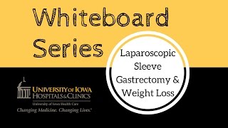 Laparoscopic Sleeve Gastrectomy and Weight Loss  Whiteboard Series [upl. by Houston]