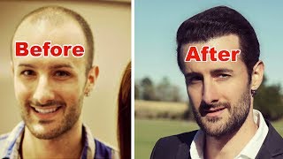 How Many Hair Transplant GRAFTS Do You Need To Achieve Density [upl. by Arvy]