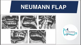 NEUMANN FLAP PERIODONTAL FLAP SURGERY TECHNIQUE DR ANKITA KOTECHA DENTAL STUDIES SIMPLIFIED [upl. by Ria]