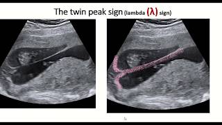 Twin peak sign or lambda sign  feature of dichorionic diamniotic twin pregnancy [upl. by Lac]