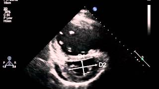 7B Parasternal short axis of the LV at the papillary muscle for LV eccentricity index PH [upl. by Nihs]