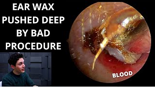 Ear Wax Pushed Down By Negligent Procedure Ear ImpressionsMouldings [upl. by Grefer616]